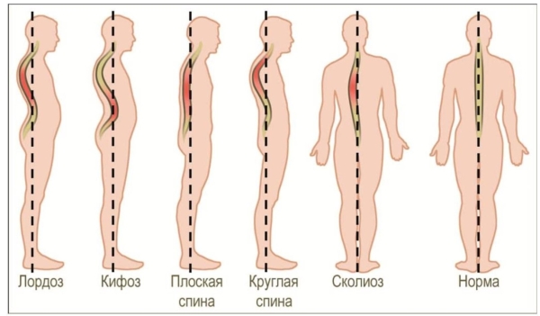 Физиологические и патологические изгибы позвоночника